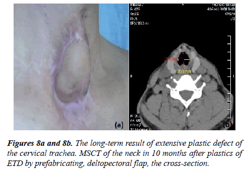 annals-cardiovascular-deltopectoral-flap