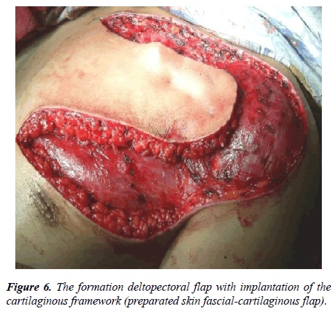 annals-cardiovascular-formation-deltopectoral