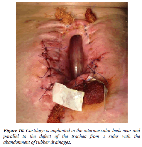 annals-cardiovascular-intermuscular-beds