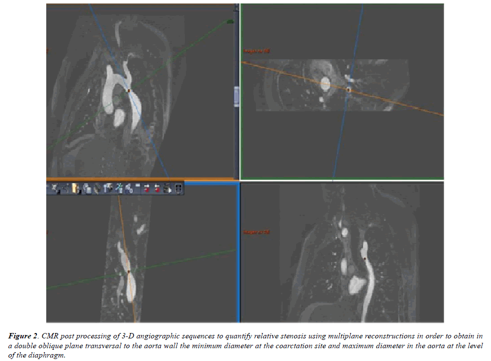 annals-cardiovascular-minimum-diameter