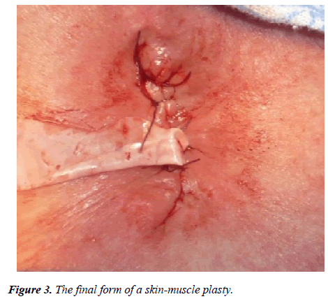 annals-cardiovascular-muscle-plasty