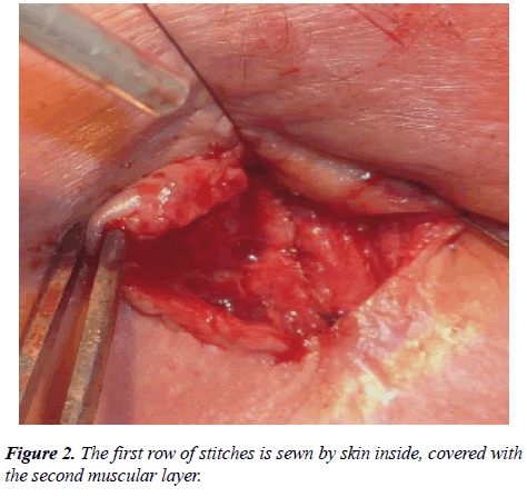 annals-cardiovascular-stitches-sewn