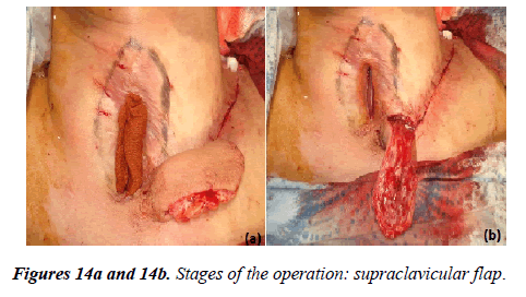 annals-cardiovascular-supraclavicular-flap