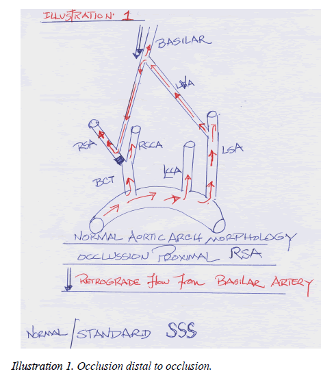 annals-cardiovascular-thoracic-surgery-Occlusion-distal