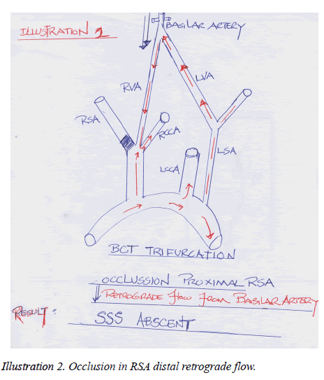 annals-cardiovascular-thoracic-surgery-distal-retrograde