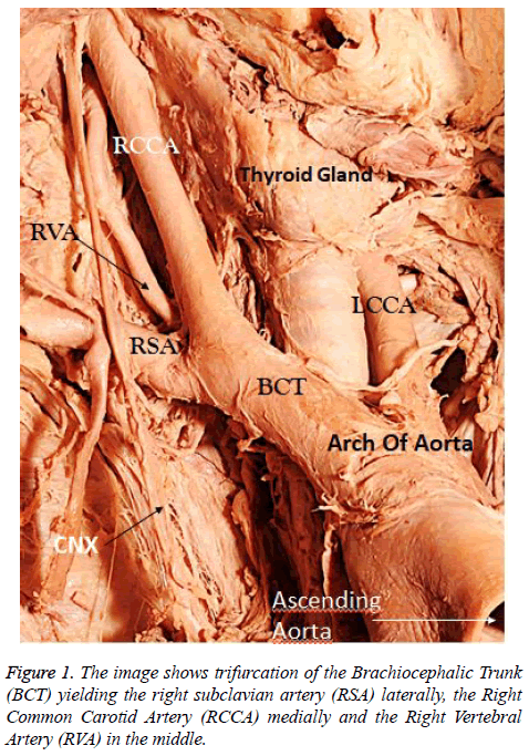 annals-cardiovascular-thoracic-surgery-trifurcation-Brachiocephalic