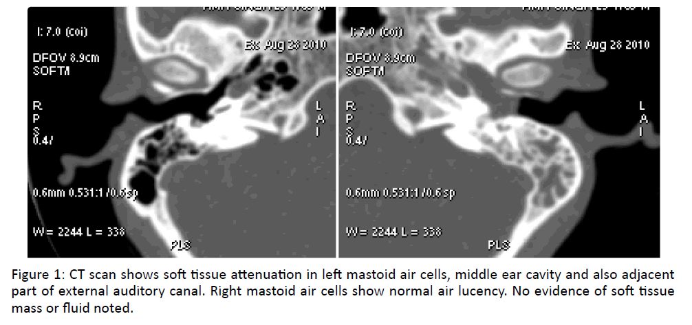 attenuation