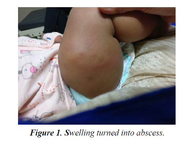 bacteriology-infectious-diseases-turned-abscess