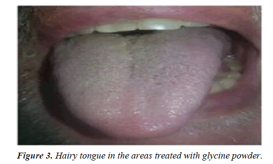 biology-medicine-case-report-Hairy-tongue
