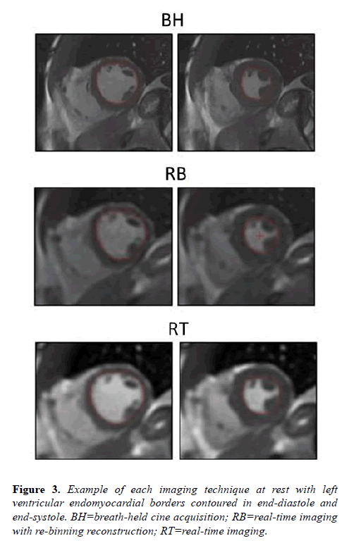 biomedical-imaging-bioengineering-ventricular-endomyocardial
