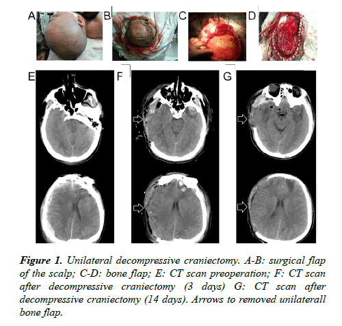 brain-neurology-decompressive-craniectomy