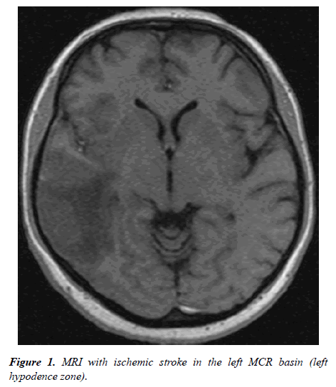 brain-neurology-hypodence-zone