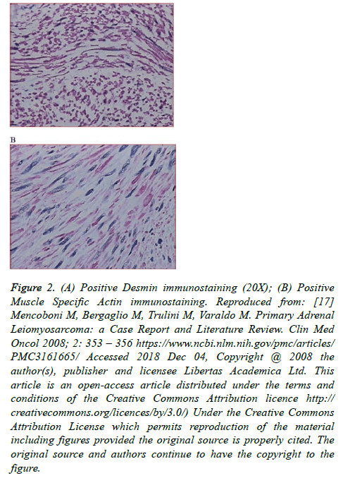 cancer-immunology-Positive-Desmin