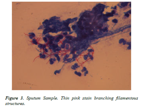 cancer-immunology-Sputum-Sample