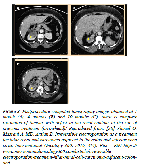 cancer-immunology-therapy-Irreversible-electroporation