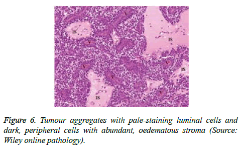 cancer-immunology-therapy-Tumour-aggregates