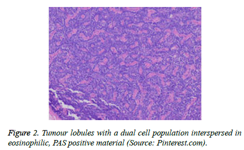 cancer-immunology-therapy-Tumour-lobules