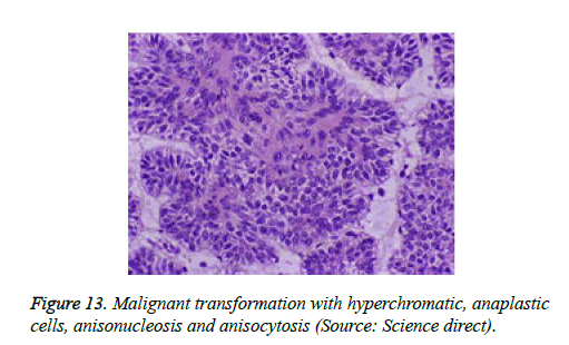 cancer-immunology-therapy-anisonucleosis-anisocytosis