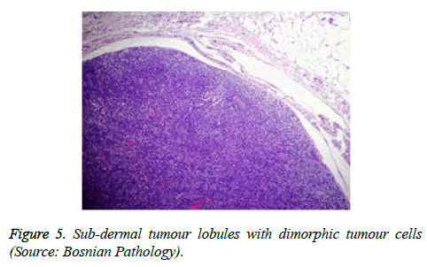 cancer-immunology-therapy-dermal-tumour-lobules