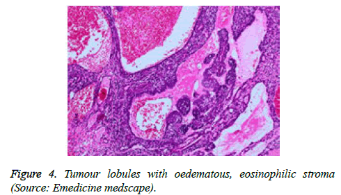 cancer-immunology-therapy-eosinophilic-stroma