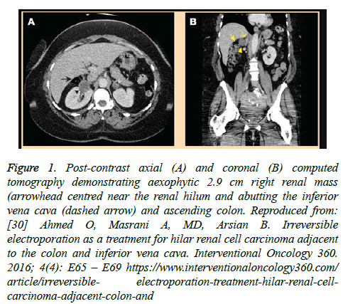 cancer-immunology-therapy-post-contrast-axial