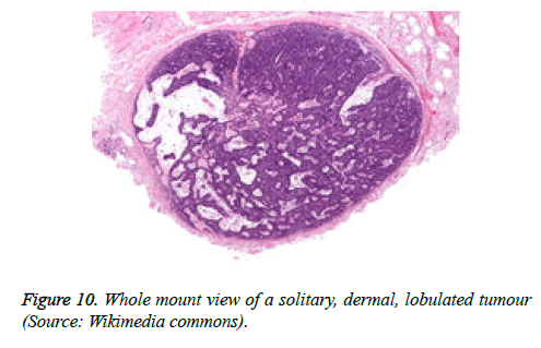 cancer-immunology-therapy-solitary-dermal