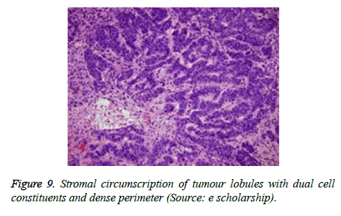 cancer-immunology-therapy-tumour-lobules