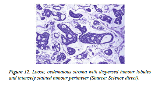 cancer-immunology-therapy-tumour-lobules