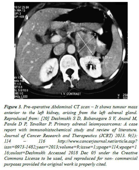 cancer-immunology-tumour-mass