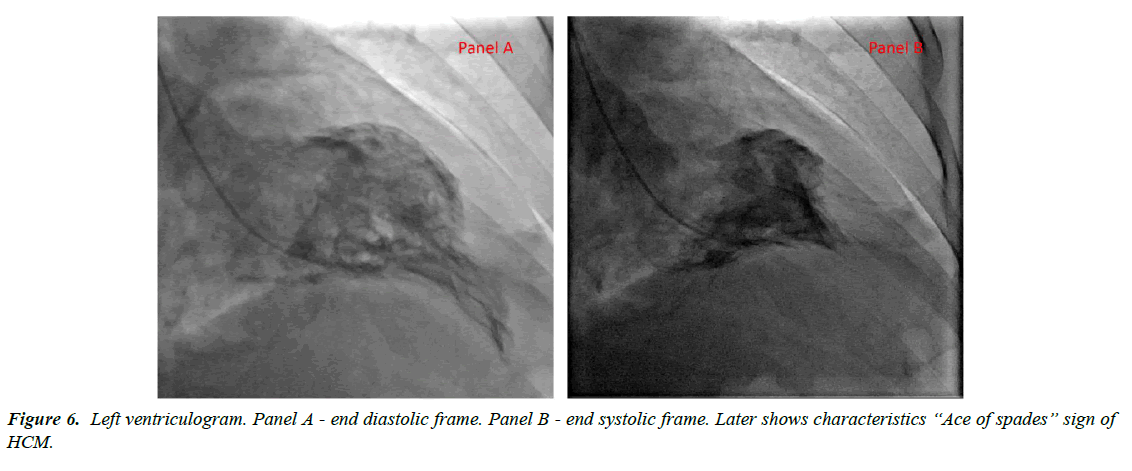 cardiovascular-medicine-Left-ventriculogram