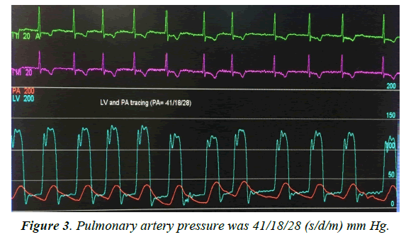 cardiovascular-medicine-Pulmonary-artery