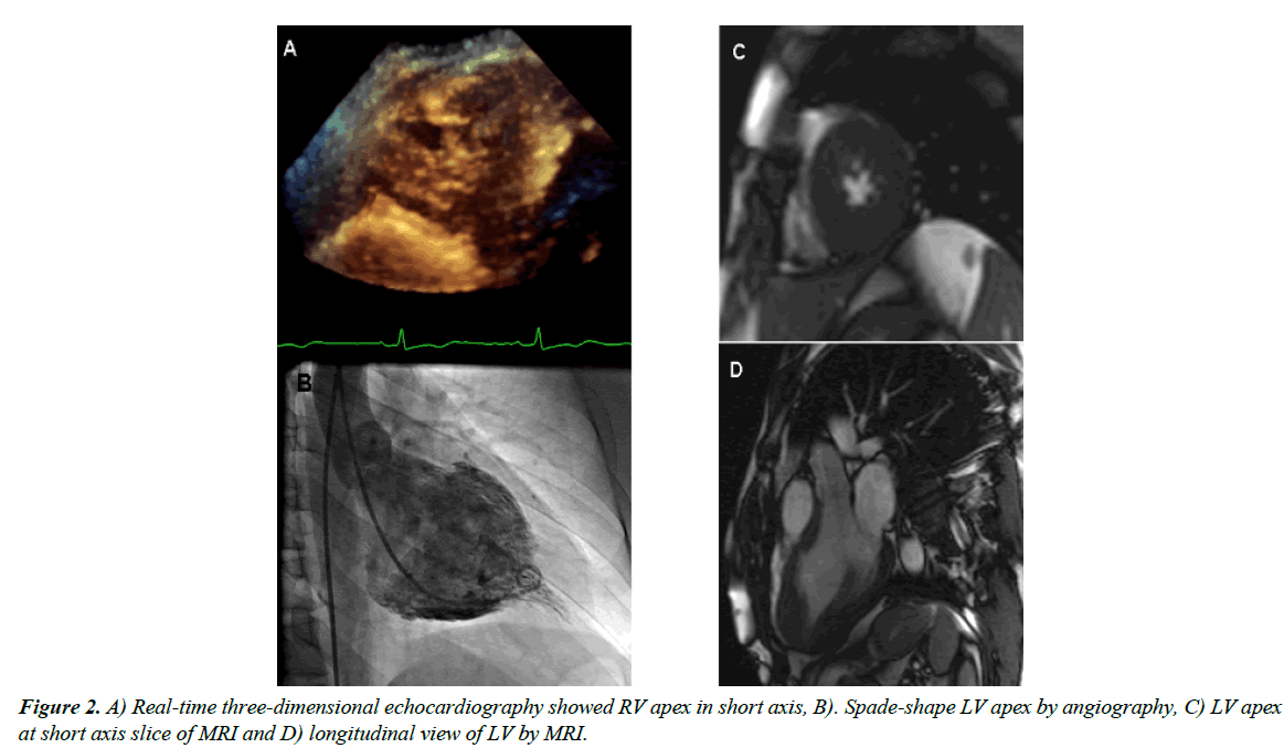 cardiovascular-medicine-apex-angiography