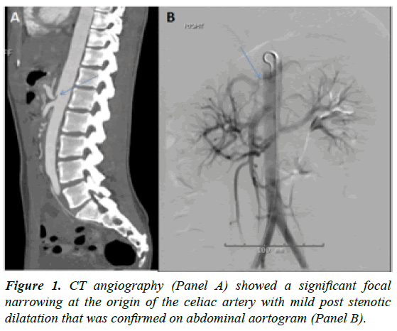 cardiovascular-medicine-focal-narrowing