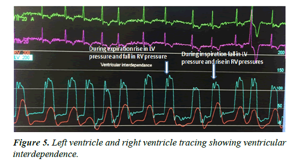 cardiovascular-medicine-right-ventricle