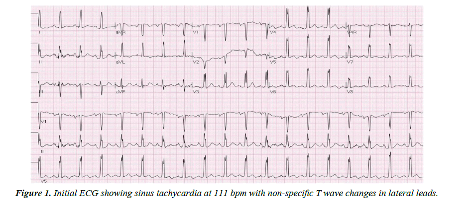 cardiovascular-medicine-sinus-tachycardia