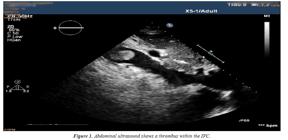 cardiovascular-medicine-therapeutics-Abdominal-ultrasound-thrombus-IVC