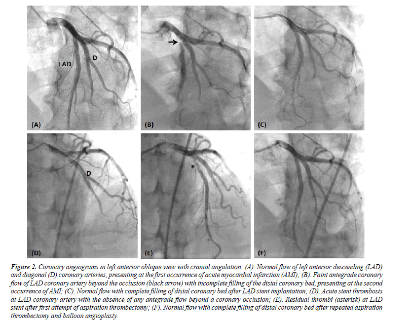 cardiovascular-medicine-therapeutics-Coronary-angiograms-left-anterior-oblique