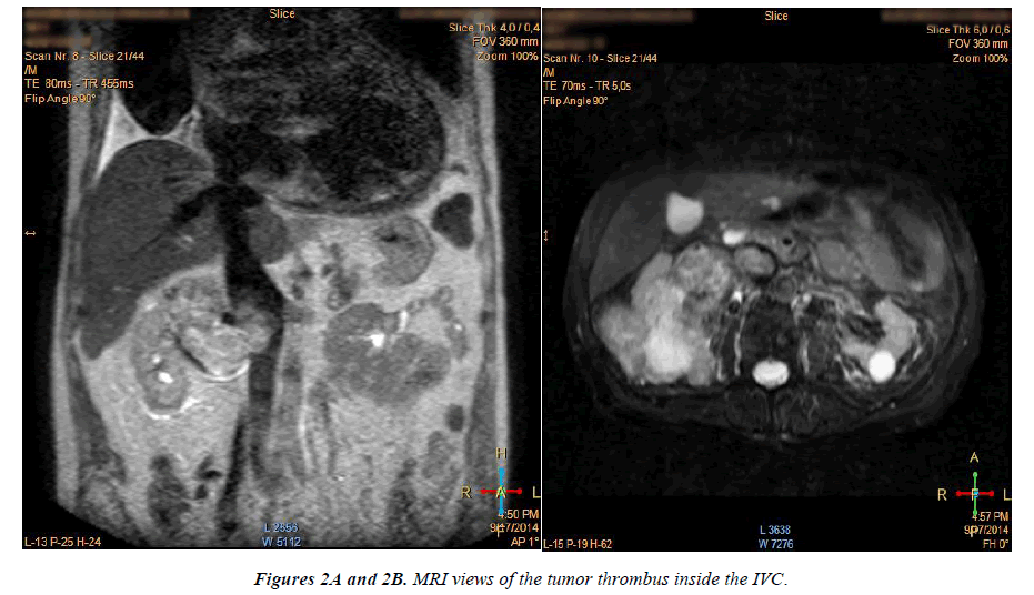 cardiovascular-medicine-therapeutics-MRI-views-tumor-thrombu-IVC