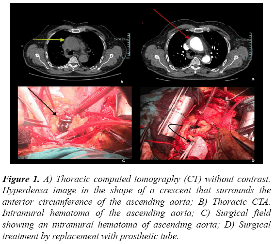 cardiovascular-medicine-therapeutics-Thoracic-CTA