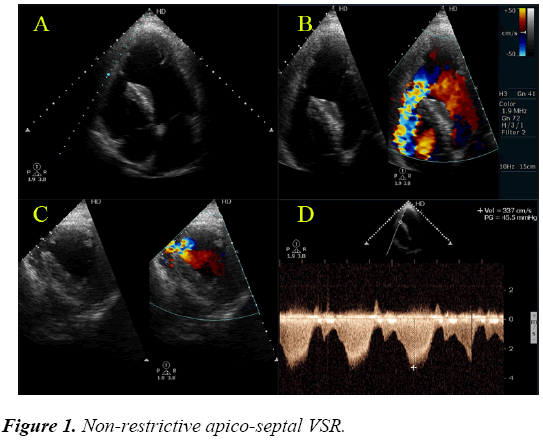 cardiovascular-medicine-therapeutics-apico-septal