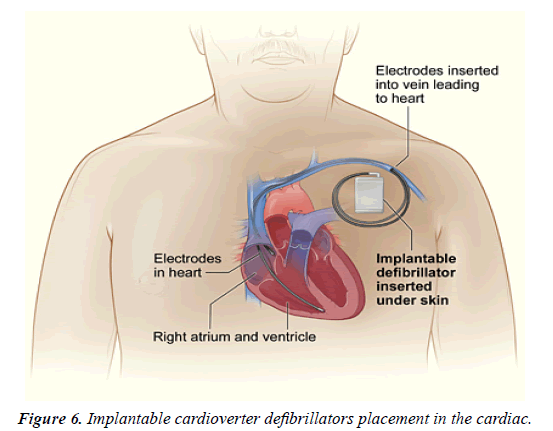 cardiovascular-medicine-therapeutics-defibrillators