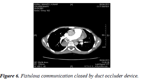 cardiovascular-medicine-therapeutics-duct-occluder