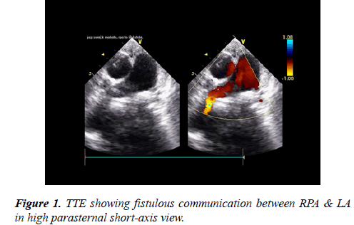 cardiovascular-medicine-therapeutics-fistulous