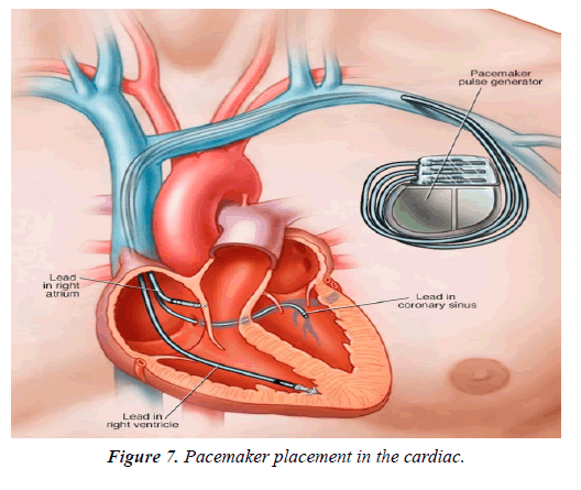 cardiovascular-medicine-therapeutics-placement