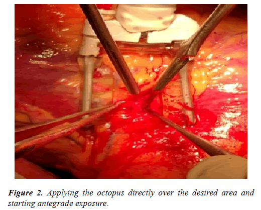 cardiovascular-thoracic-surgery-antegrade-exposure