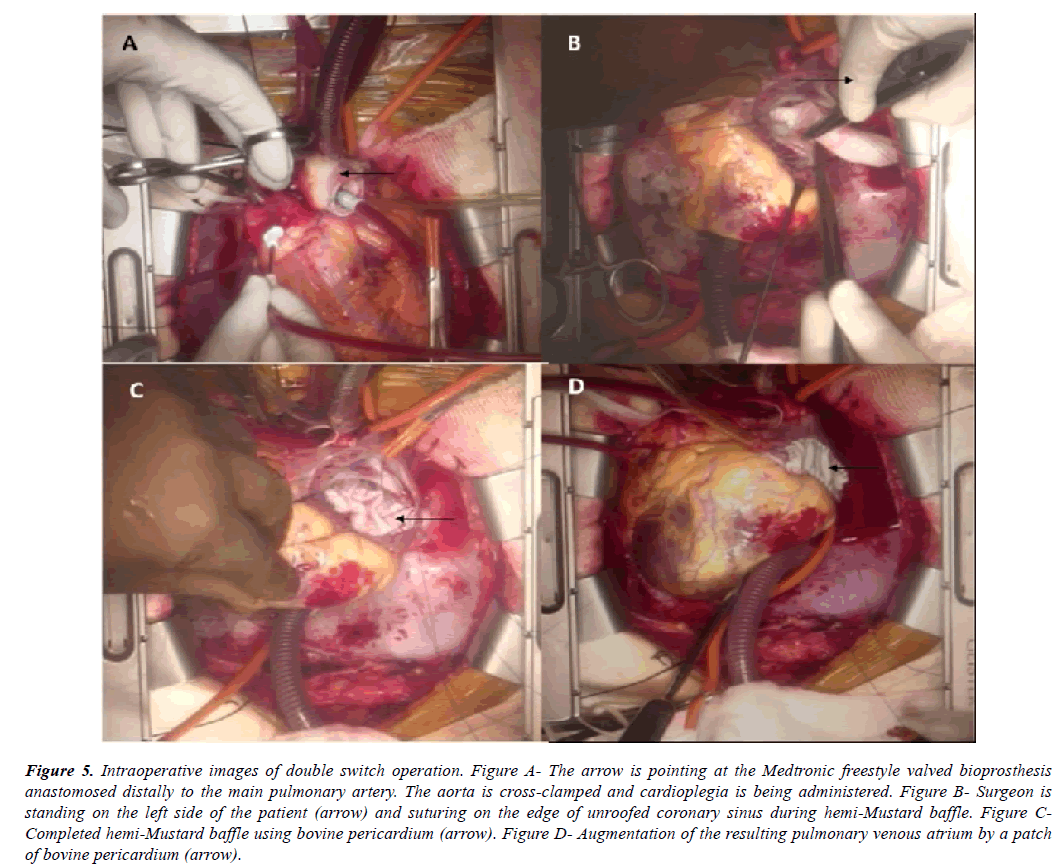 cardiovascular-thoracic-surgery-double-switch