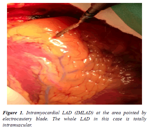 cardiovascular-thoracic-surgery-electrocautery-blade