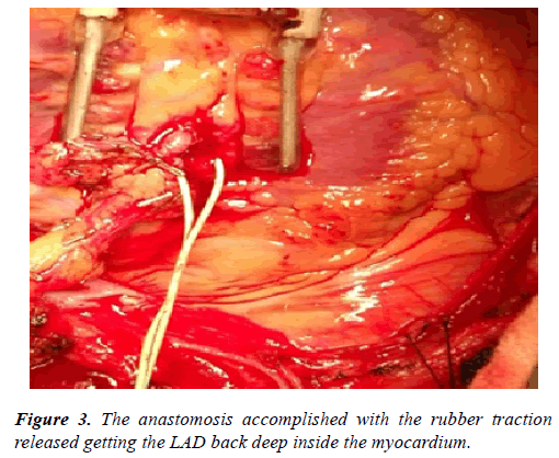 cardiovascular-thoracic-surgery-rubber-traction