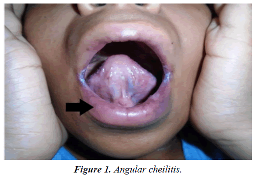 case-reports-in-surgery-invasive-procedures-Angular-cheilitis