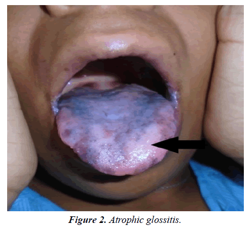 case-reports-in-surgery-invasive-procedures-Atrophic-glossitis